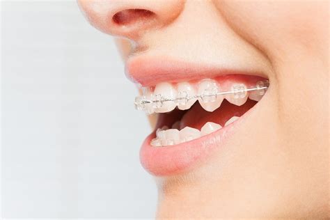 brackets bandas metalicas|bandas de ortodoncia beneficios.